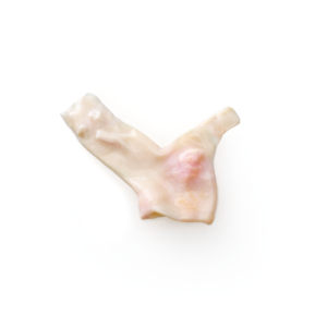Pulmonary Artery Conduit