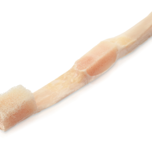 Hemi Patellar Tendon without Quadriceps Extensor, Aseptic